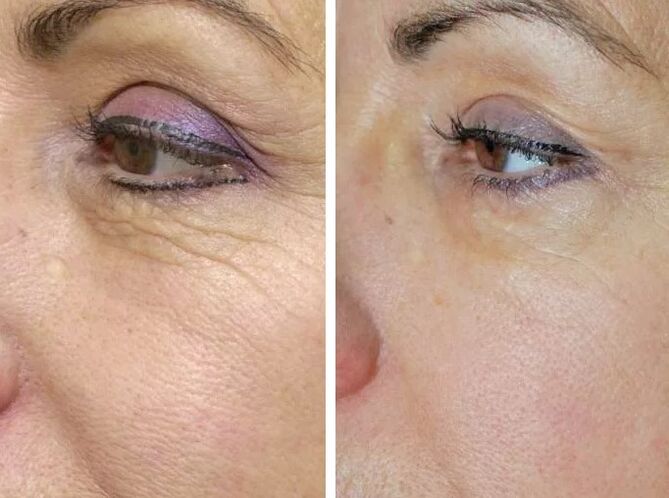 Полев лазер преди и след