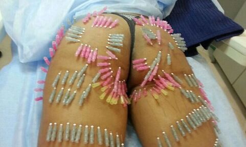 повдигане на дупето